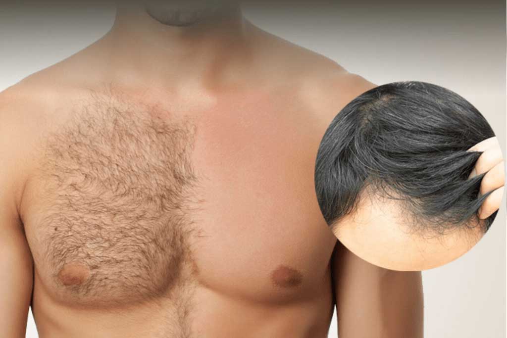 Body hair donor strategy topic image