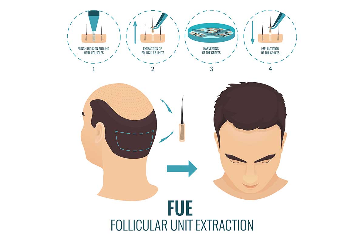FUE hair restoration topic image