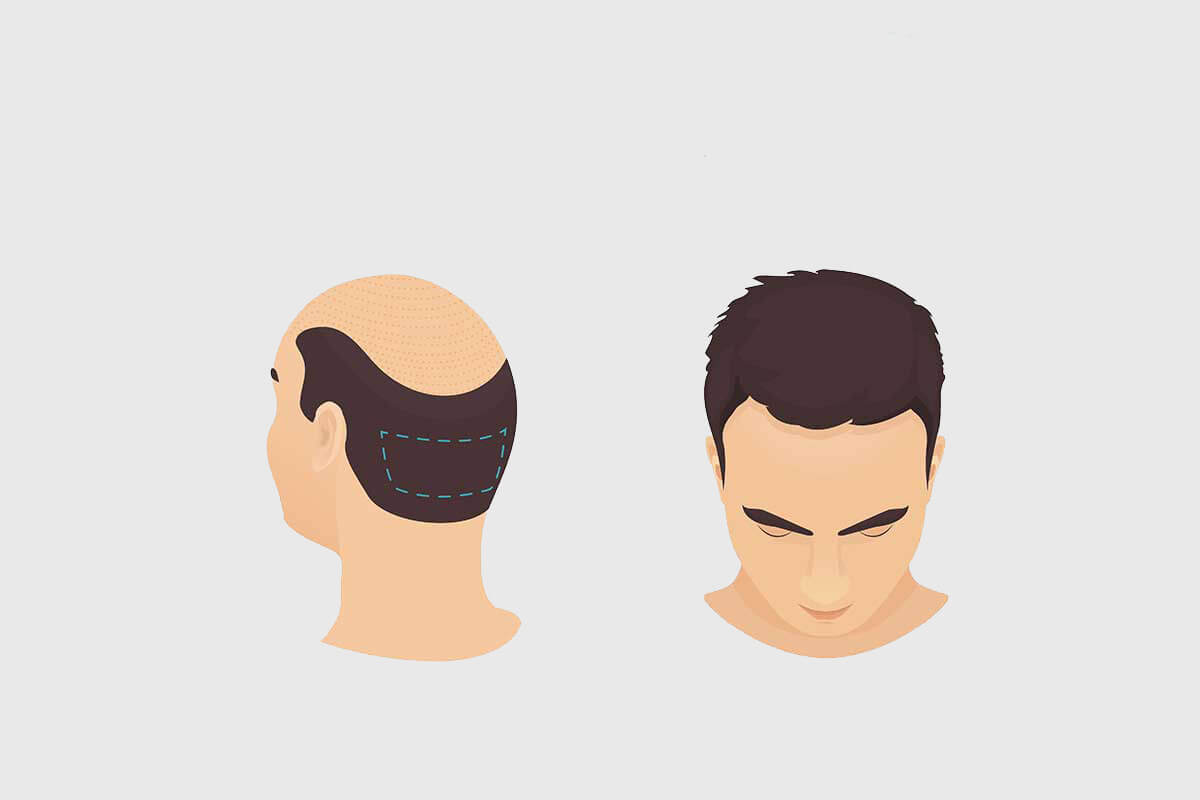 FUT and FUE hair transplant combination