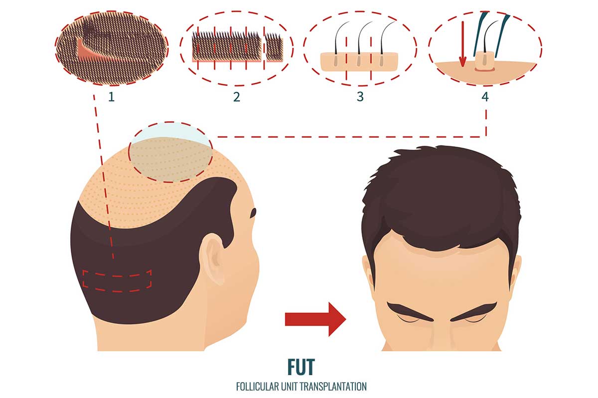 FUT hair restoration topic image